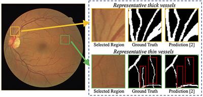 Pyramid-Net: Intra-layer Pyramid-Scale Feature Aggregation Network for Retinal Vessel Segmentation